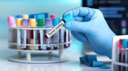 圖片 癌症指標是什麼？檢測原理| 準確度| 與其他癌症檢測差異